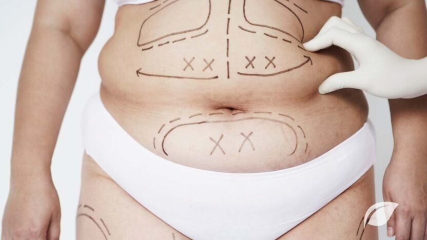 Liposuction ile Zayıflama